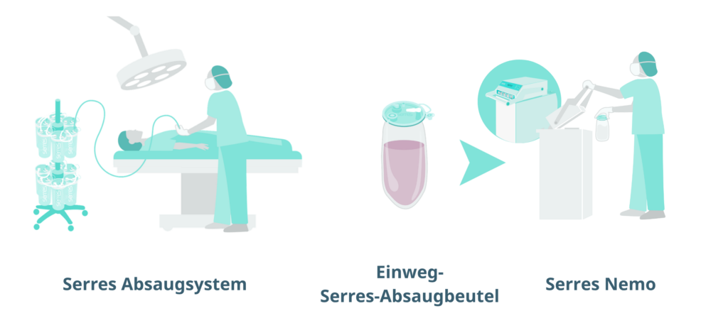 Illustration des OP-Ablaufs mit dem Serres-Saugsystem und Serres Nemo.